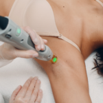 Laser Hair Removal